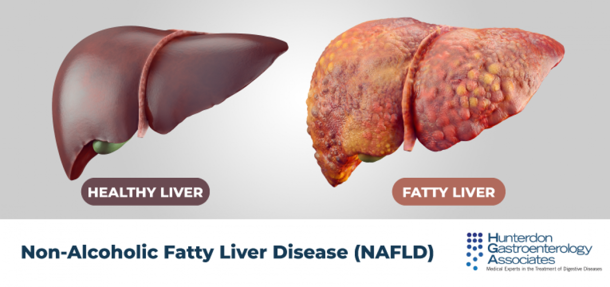 fatty liver treatment